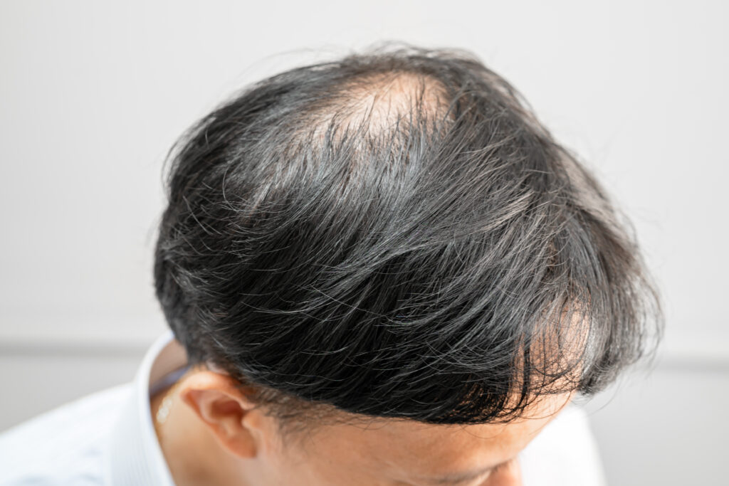 signos de alopecia en hombres