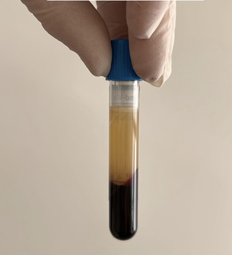 mano agarrando tubo con extracción de sangre