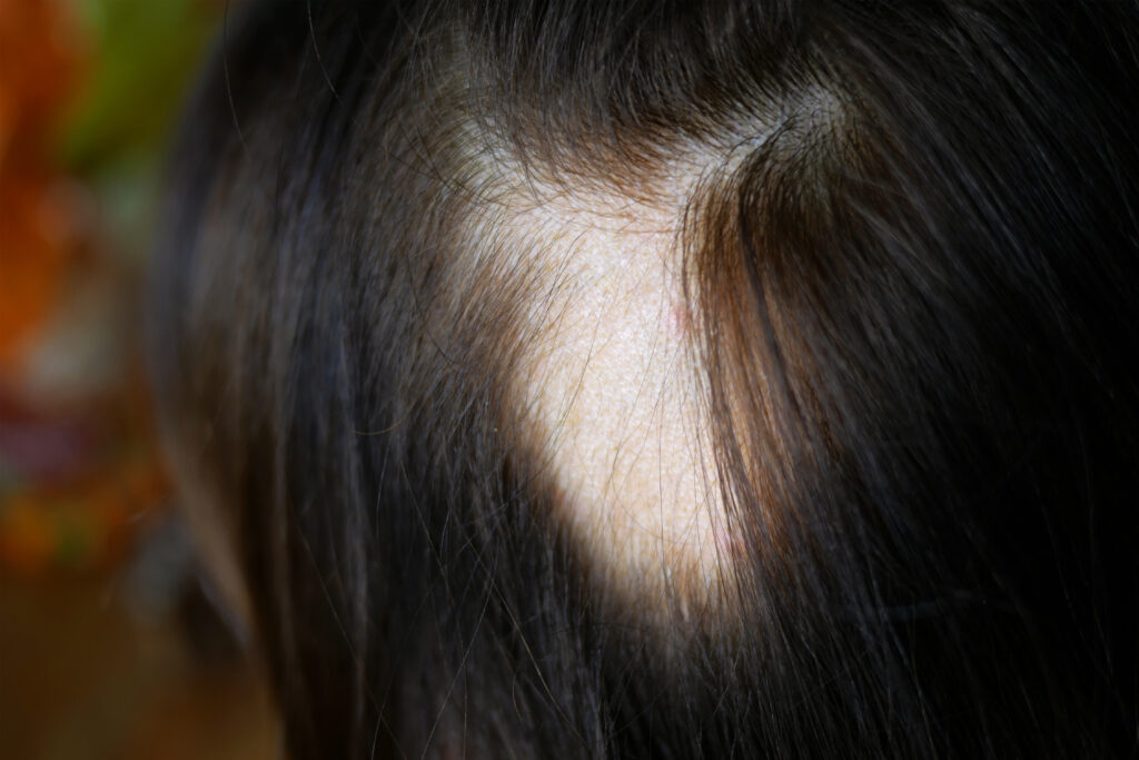 signos de alopecia en mujeres