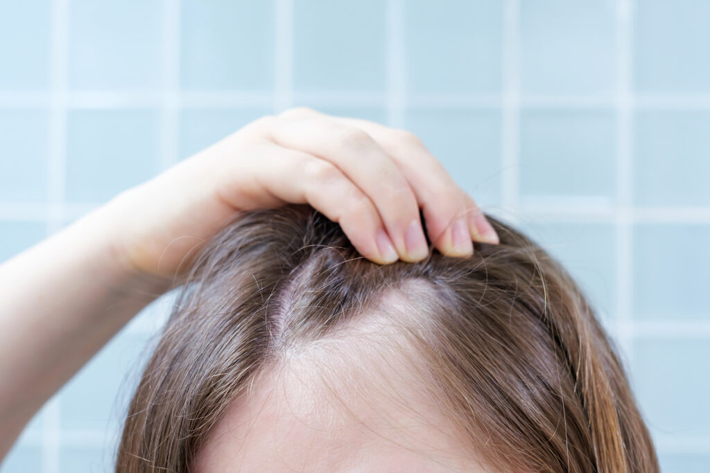 mujer mostrando su cuero cabelludo